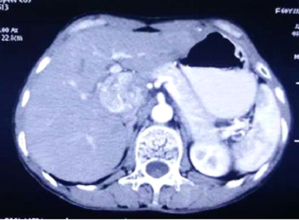 我院成功实施腹腔镜肝尾状叶恶性肿瘤切除术